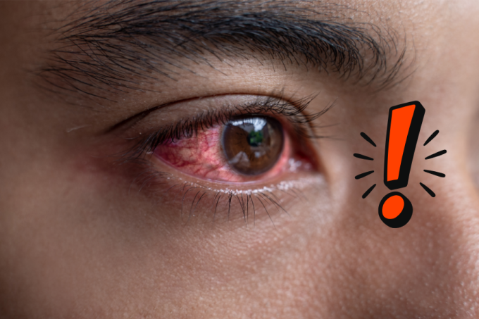 5 najczęstszych infekcji oka - powody, objawy i leczenie 