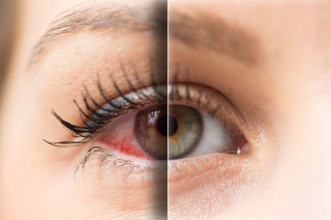 Opryszczka na oku - przyczyny