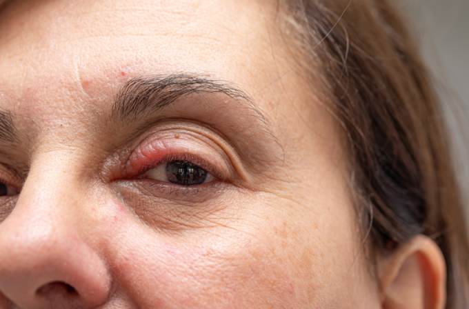 Spuchnięta powieka