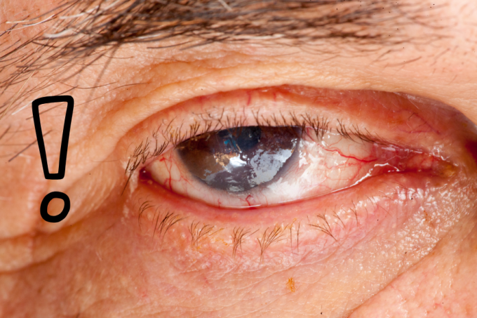 Zapalenie tęczówki - jakie przyczyny, objawy, leczenie